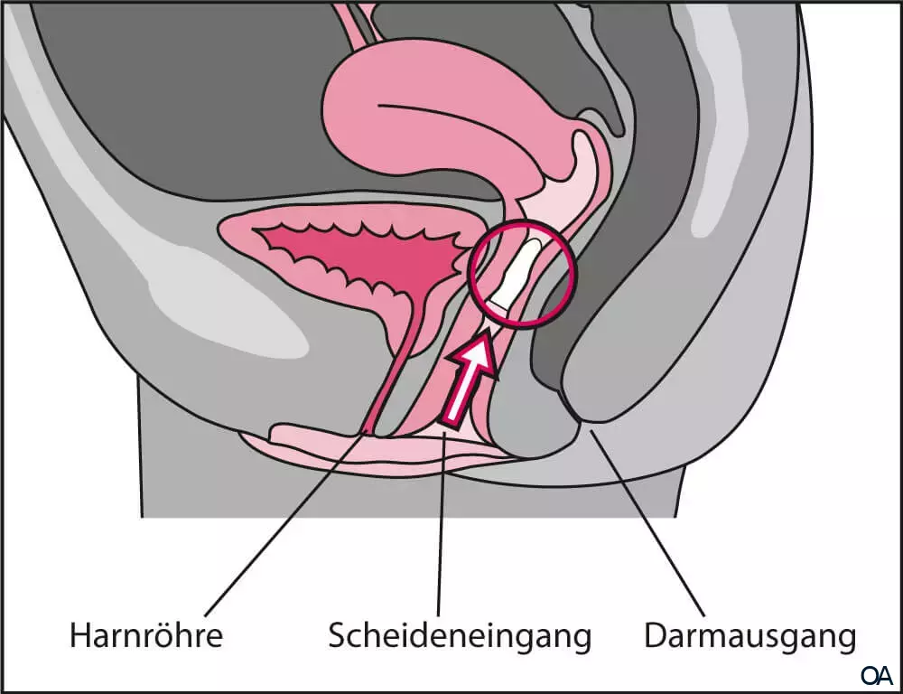 Vagisan FeuchtCreme Cremolum Zpfchen - Linderung bei Scheidentrockenheit Vagisan FeuchtCreme Cremolum Zpfchen - Linderung bei Scheidentrockenheit